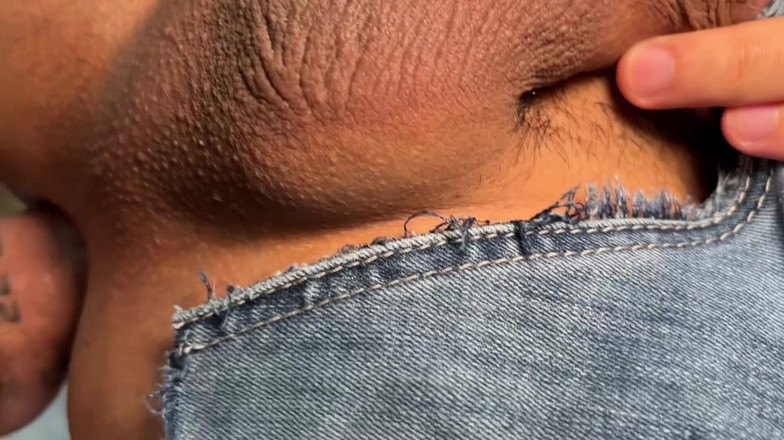 Johnny Hakson: punggung gelembung saya