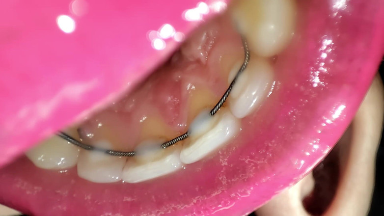 Princess18_: Tour della bocca di una trattenuta permanente