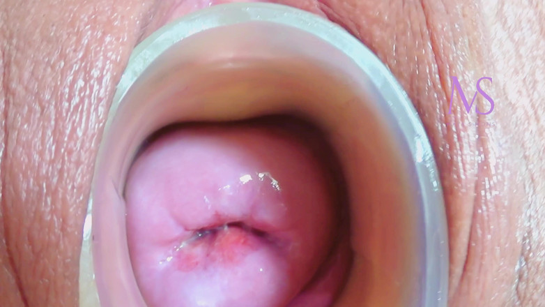 Maya Simons: 子宫颈和中线脱垂