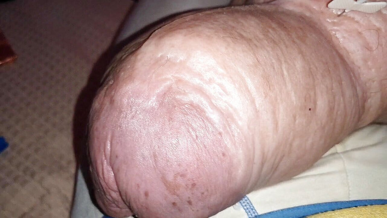 Monster_Meat_: 2liter glucose 'auf halbem Weg' meiner Doppelinjektion