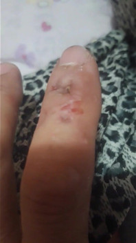 Fingerbiss