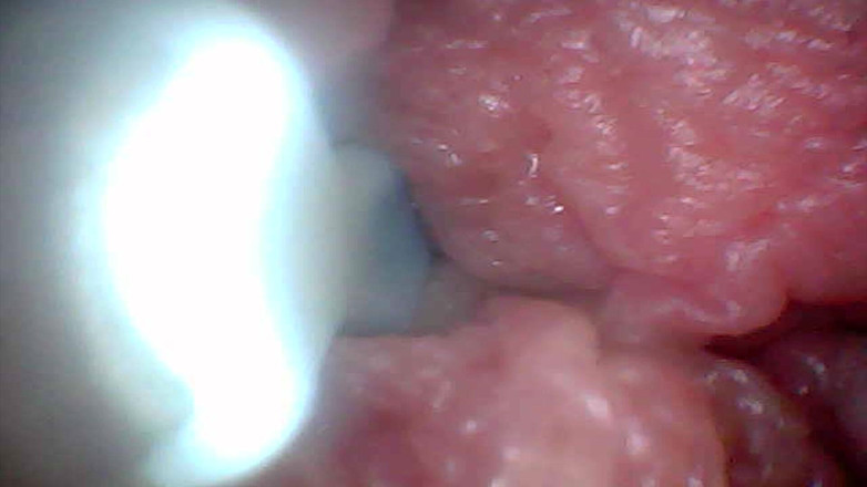 Twittiy: Kamera Endoskopi Menunjukkan Bagian Paling Sensitif dari Video Pendidikan Penis