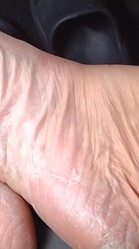 Sweaty Feet