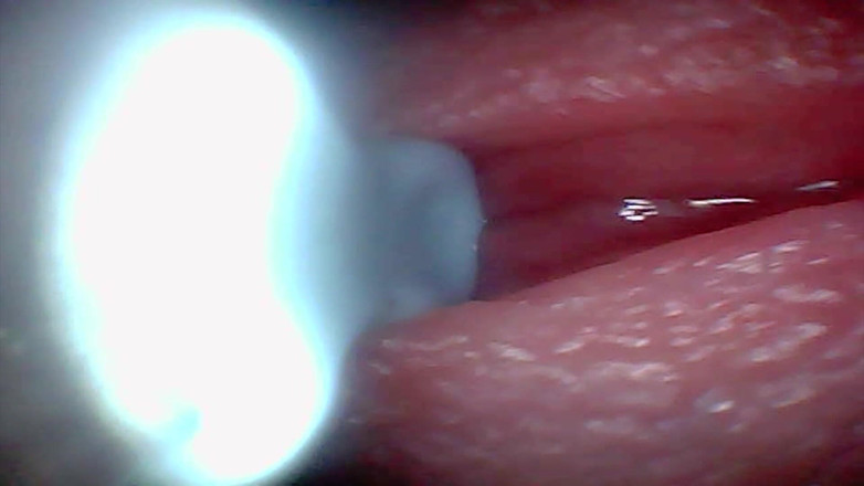 Ladybottox: Endoscope Camera Captures Moment of Male Ejaculation 4K