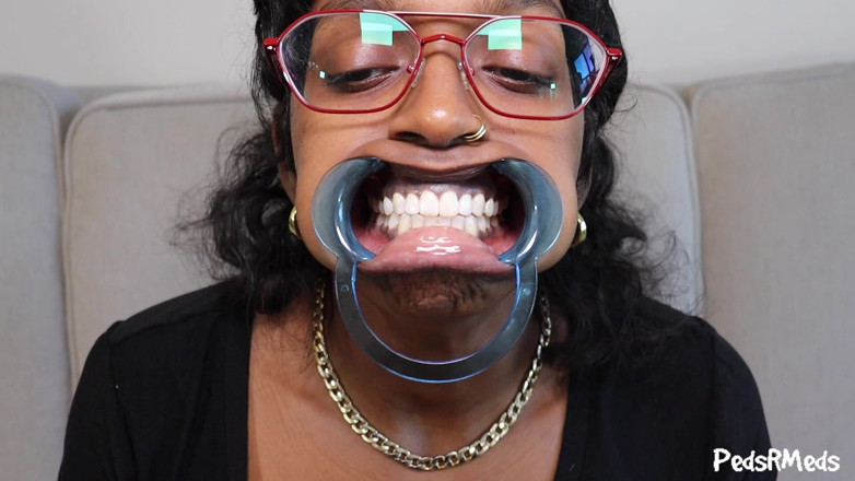 PedsRMeds: Youronlyphoenix Dental Retractor Mouth Tour