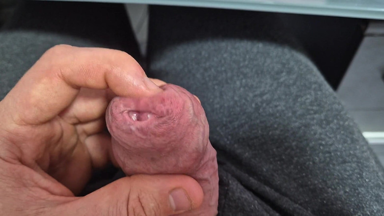 GloomyChase977: 사정으로 쪼이는 Phimosis 포피 스트레칭!