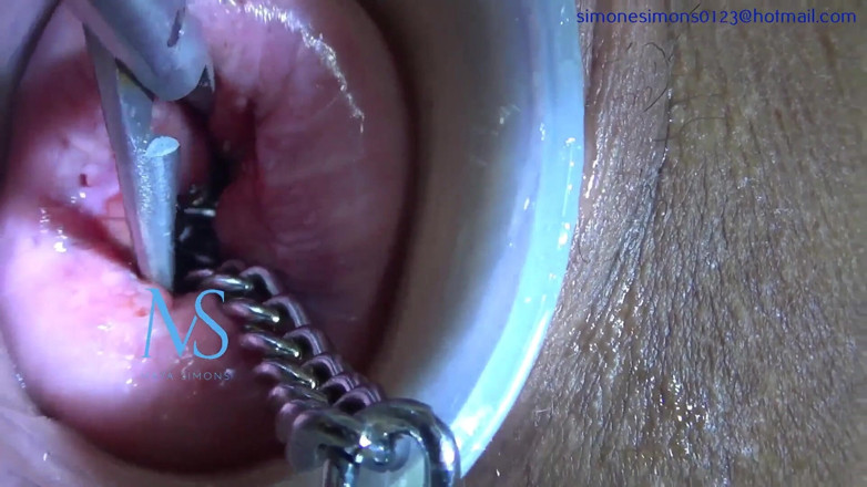 Maya Simons: Dance with Prolapsed Cervix Chain
