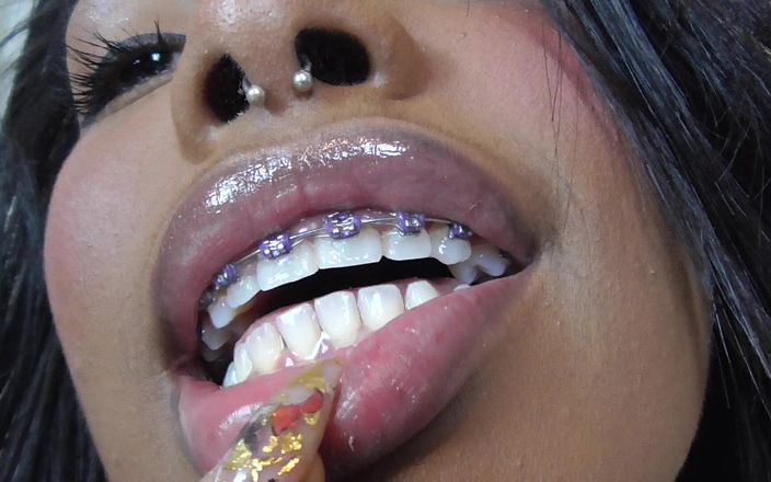 Solo Austria: Black girl teeth brace fetish!