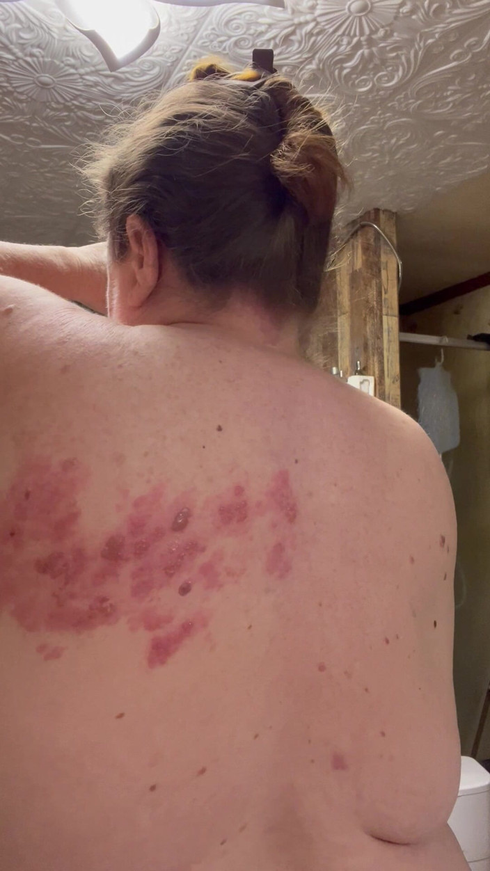 PlayfulRose1: Bad Case of Shingles