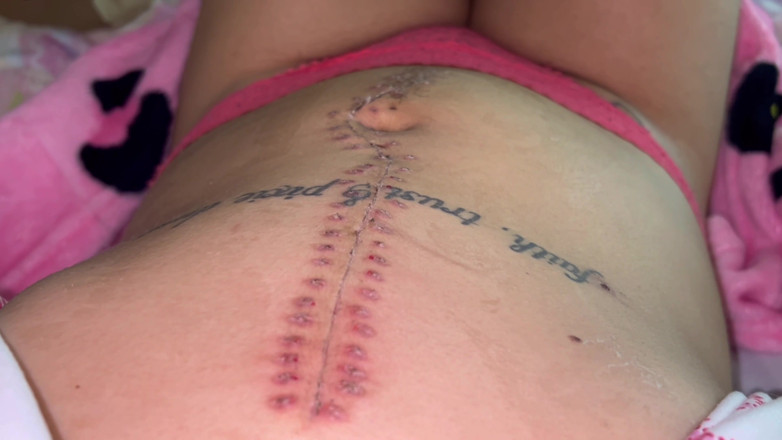 Nali Marie: Scar fetisches heftet heftet Krankenhaus-erholung nach der operation teen zierliche...